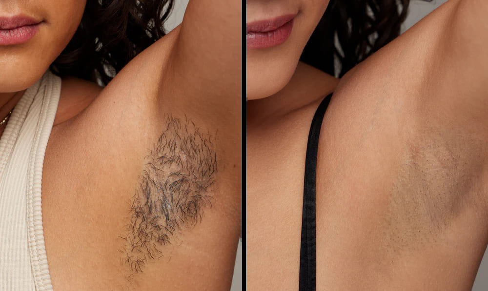 Axilas antes y después